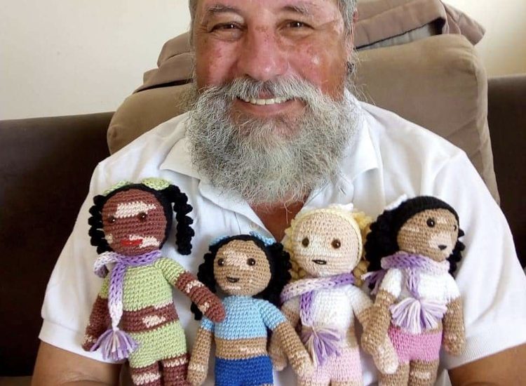 This Brazilian grandfather has vitiligo, and he crochets dolls for kids with the same condition