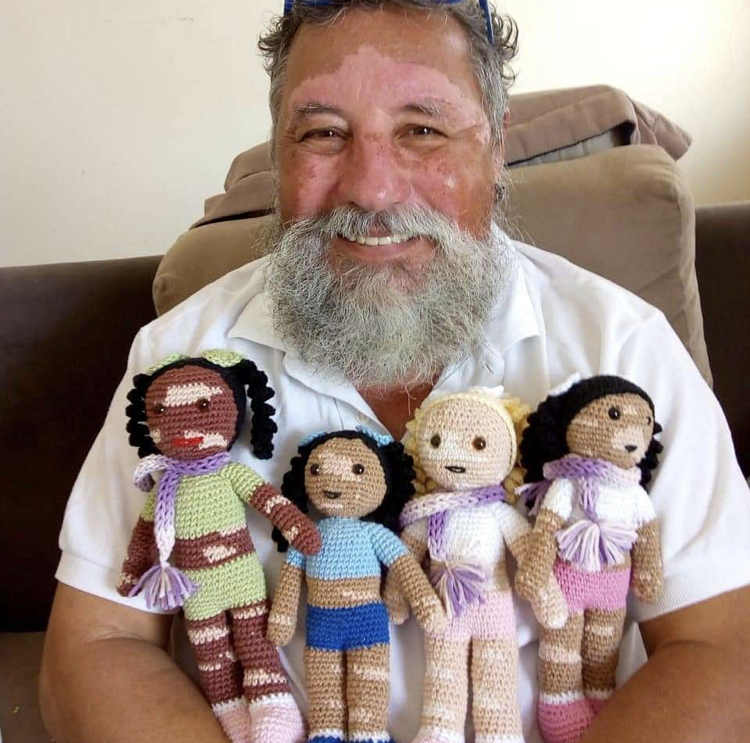 This Brazilian grandfather has vitiligo, and he crochets dolls for kids with the same condition